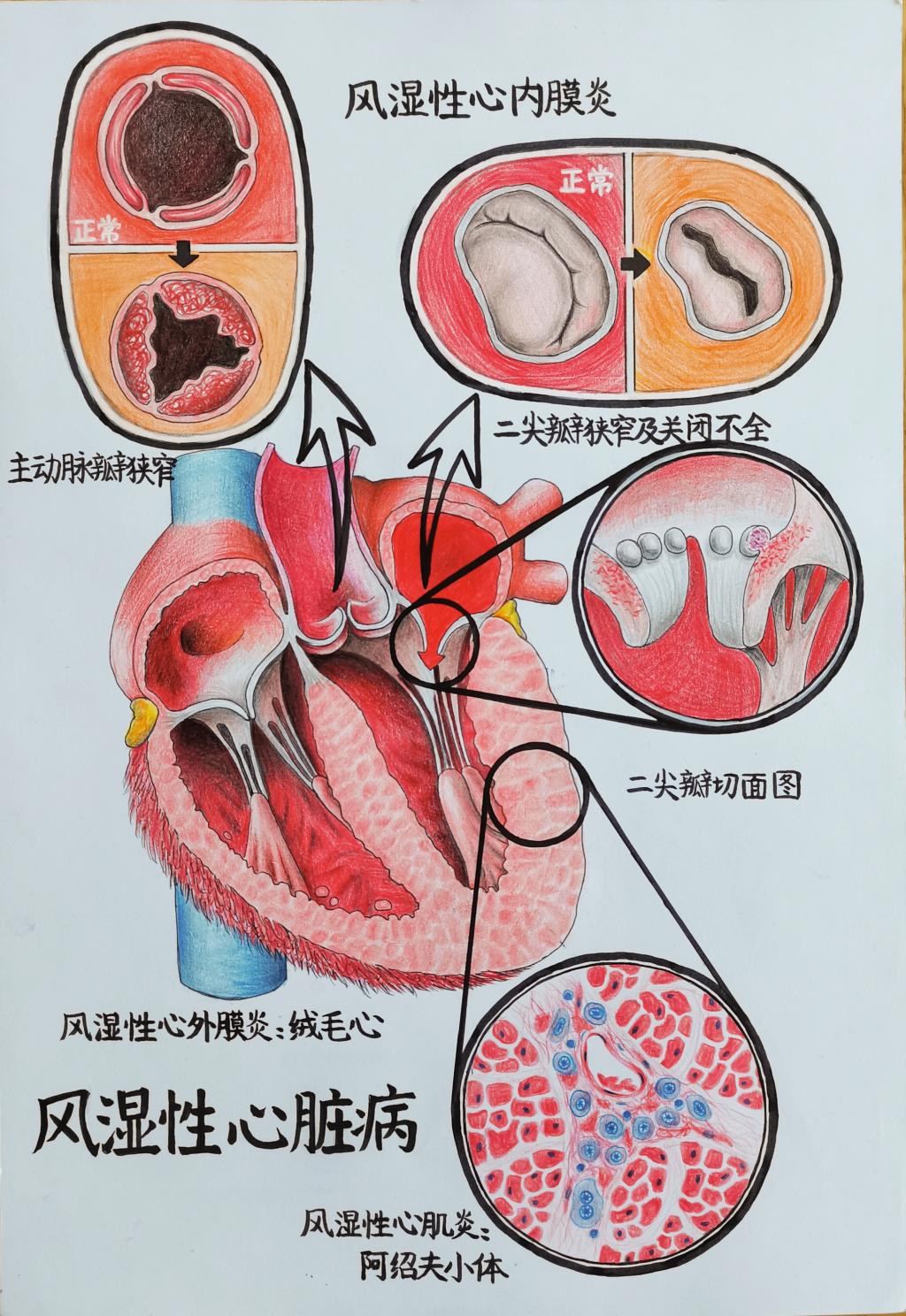 2. 邮寄手绘 作品分类 2 风湿性心脏病 做爱自拍
张晨彤